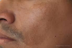 La dermatóloga elia roó te da todas las claves. Tratamiento Del Melasma Didac Barco