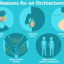 Read about testicular cancer (cancer of the testicle), including information about symptoms, causes, diagnosis and treatment. Everything You Need To Know About An Orchiectomy