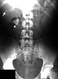 Renal Calculus Disease Radiology Key