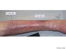 Some causes of senile purpura include: Wounds Secondary To Dermatoporosis Or Chronic Cutaneous Insufficiency