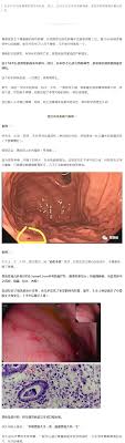  流行病学  消化道肿瘤中占第一位 , 全部恶性肿瘤中占第三位 ( 男性 : èƒƒç™Œçš„ æ—©æœŸç—‡çŠ¶ å°±æ˜¯æ²¡æœ‰ç—‡çŠ¶ æœ‰ç—‡çŠ¶çš„å·²ç»ä¸æ—©äº† èƒƒç™Œ èƒƒç™Œ