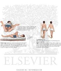 Image result for Perthes Test