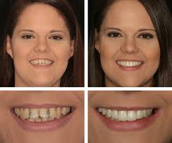 INVISALIGN CLEAR BRACES