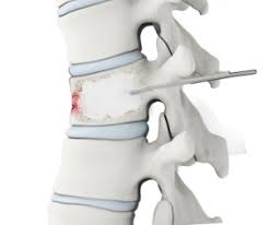 Image result for Vertebral Compression Fracture
