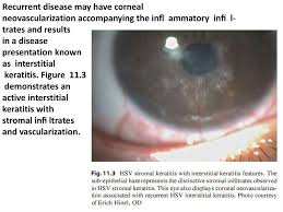 In contrast, patients with epithelial keratitis alone have no. Pediatric Hsv Epithelial Keratitis Online Presentation