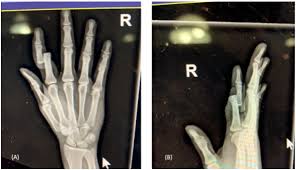 Image result for Interphalangeal Dislocation