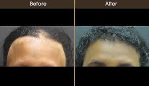 These cells give our skin and hair color. Hair Loss Nyc Psoriasis Vitiligo New York