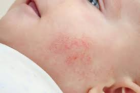 Does Early Teething Cause More Rashes? Parent Tips