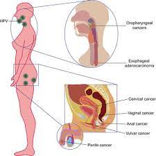 Though usually harmless, some types of hpv cause cervical lesions that, over a period of time, can develop into cancer if untreated. Frontiers Immunodiagnosis And Immunotherapeutics Based On Human Papillomavirus For Hpv Induced Cancers Immunology