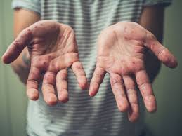 Hand Fuss Mund Krankheit Symptome Behandlung