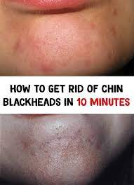 How To Get Rid Of Chin Blackheads In 10 Minutes Blackheads How To Get Rid Of Acne Beauty Tips For Hair