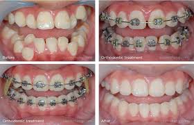 Topten.hotdeals.com has been visited by 100k+ users in the past month Orthodontics Braces Aligner Roomchang Mobile Website