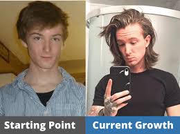 The hair is just stating to come out, and as expected, it is thin and space. Hair Growth Journey Before Afters From Our Members