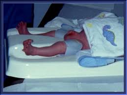 Image result for Neonatal Circumcision