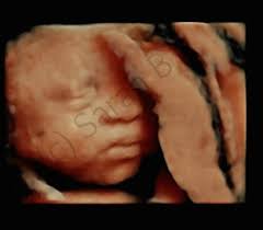 Downs syndrom är en kromosomrubbning som medför att utseendet får vissa karaktäristiska drag och en varierande grad av utvecklingsstörning. Del 1