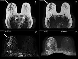 It may cause your breast to enlarge or swell, be tender, warm to the touch, look like an infection, or look like typical diagnosis is made through mammogram, possibly ultrasound or mri and biopsy. Ovarian Cancer Metastatic To The Breast Presenting As Inflammatory Breast Cancer A Case Report And Literature Review