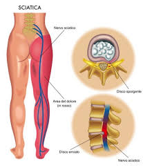 Sciatica (o sciatalgia) è il nome con cui viene identificato un dolore che si irradia sulla parte posteriore della gamba, si tratta quindi più propriamente di un sintomo la parola sciatica (o sciatalgia) è riferita al dolore che si irradia lungo il percorso del nervo, cioè dalla schiena verso le natiche e le gambe. Sciatalgia Sintomi Cause Tutti I Rimedi Cure Naturali It