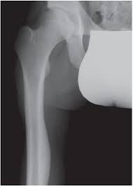 In the absence of treatment metastasis is observed, with the lungs primarily affected. Bone Tumors Of Childhood Benign Or Malignant Consultant360