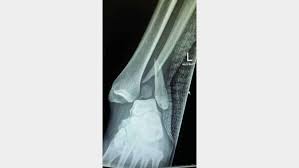 Image result for Ankle Dislocation