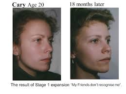 Facial muscle posture can be a giveaway for dental arch development. At a  dinner party, for the trained eye, you can spot those orthodontically  treated, or those who need it :D It