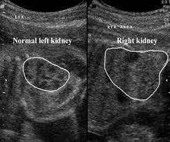 Mesoblastic Nephroma Renal Tumors Renal Tumor Text