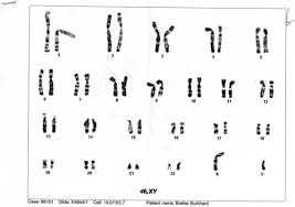 Factors such as maternal age and health history play into statistics about translocation carriers and their pregnancies. Translocation Trisomy 21 Robertsonian Trisomy 21 Prince Vince Meets The World