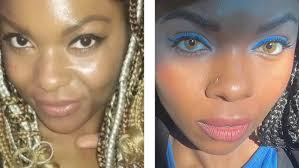 Surgery to change eye color in India