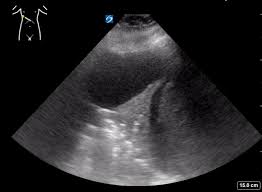 Image result for Air Bronchogram