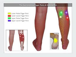 gastrocnemius trigger points the calf cramp trigger points