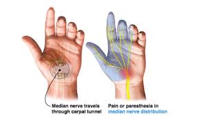 Carpel Tunnel Syndrome