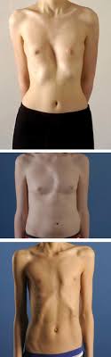 Information and translations of pectus in the most comprehensive dictionary definitions resource on the web. Pectus Excavatum And Carinatum Sciencedirect
