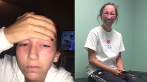 Maybe you would like to learn more about one of these? Poison Ivy In The Eye What To Do Poison Ivy Around Your Eyes