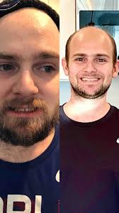 Fundraiser by Brandon Morgeson : Help Nick dental restoration