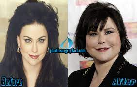 Tragic plastic surgery is one thing, turning a formerly beautiful woman into herve . Delta Burke Plastic Surgery Before And After Pictures Plastic Surgery Facts