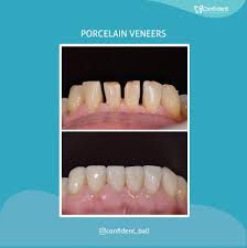 With reasonable precautions, dental veneers can last anywhere from 10 to 30 years. Confident Bali Dental Clinic Best Dentist In Bali