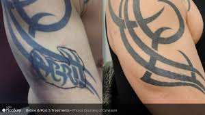 How many tattoo removal treatments are needed to get rid of the tattoo completely? Laser Tattoo Removal Imperial Valley And Yuma El Centro Dermatology