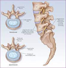 The ligamentum flavum, or the yellow ligament, is a thick, segmental ligament that runs between the lamina of adjacent vertebrae (fig. The Complexity Of Lumbar Spinal Stenosis The Rheumatologist