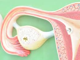 Stage 1 ovarian cancer is the least advanced and stage 4 ovarian cancer the most. Early Symptoms Of Ovarian Cancer What Does It Feel Like