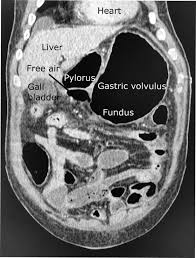 Image result for Volvulus