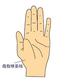 第56回理学療法士国家試験解説AM-05 正中神経麻痺に用いる装具 | なぜなに。装具 まとめ さん