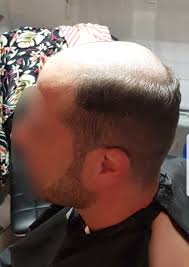 Cela s'observe dans un premier temps avec une chute des cheveux à l'avant, au niveau de la ligne de front, ou du vertex. Photos Resultat Complement Capillaire Homme