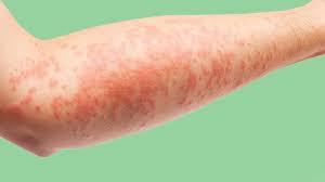Fortunately, treating hives is possible with your doctor's help and guidance. Hives Histamine And Vitamin D