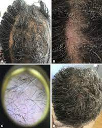 Hay ic, jamieson m, ormerod ad. Ixekizumab Induced Alopecia Areata Jaad Case Reports