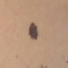 In the united states, it's estimated that doctors diagnose over 100,000 new skin cancer cases each year. Skin Cancer Pictures Includes Moles And Other Skin Spots