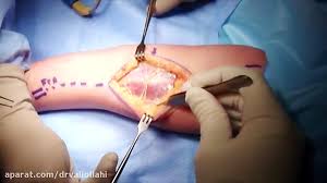 محمد ابن سیرین می گوید: Pronator Teres Sparing Approach To The Volar Radius Vumedi Mp4