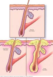 Ingrown hairs usually happen when you try to remove hair, and aside from ingrown hairs, here are a few other things that could look like a bump on your bikini line they can show up as a small bump or group of bumps, can be flat or look bumpy like cauliflower, and can appear on the groin, according. Folliculitis Symptoms And Causes Mayo Clinic
