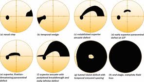 Visual Field Test Visual Field Test Results Interpretation