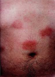 Image result for Panniculitis