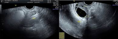 Clearly defined symptoms usually do not occur until the cancer spreads, and the list of early symptoms contains a number of symptoms that. Residual Ovarian Syndrome A Case Report With Classic Symptoms Imaging And Pathology Findings And Treatment Sciencedirect