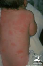 Image result for sweat rash on back baby